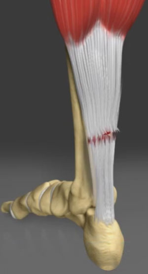 Achilles Tendon Problems