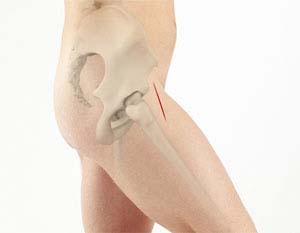 What is a Total Hip Replacement? - Brisbane Physiotherapy