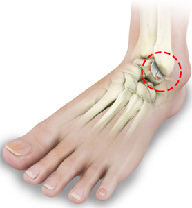Arthritis Of Foot