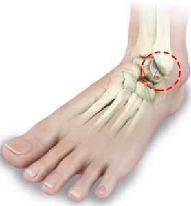 Foot and Ankle Arthritis