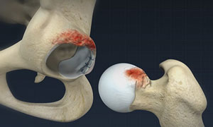 Femoroacetabular Impingement