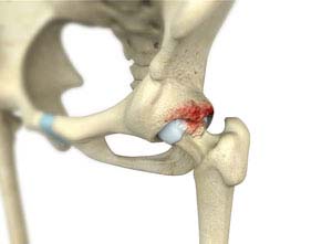 Hip Impingement