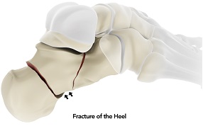 Calcaneal Fractures