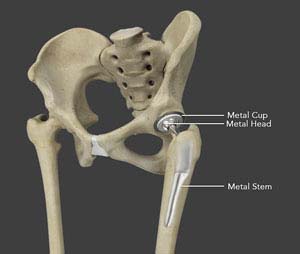 Hip Replacement Surgery