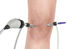 Arthroscopy of the Knee