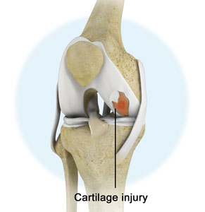 Knee Cartilage Defects
