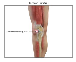 Knee Bursitis