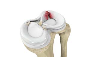 Knee Meniscus Tears