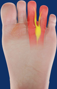 Morton’s Neuroma