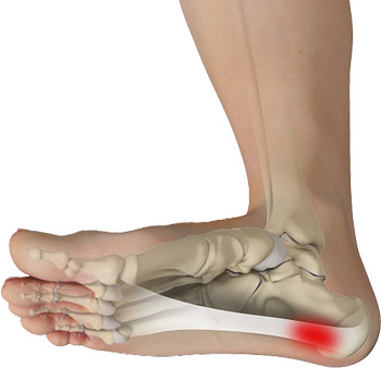 Shockwave Therapy Brisbane - Plantar Fasciitis Treatment