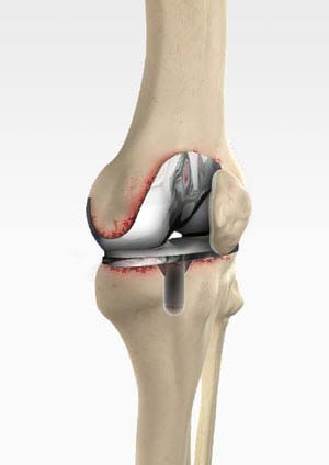 Revision Knee Replacement Surgery